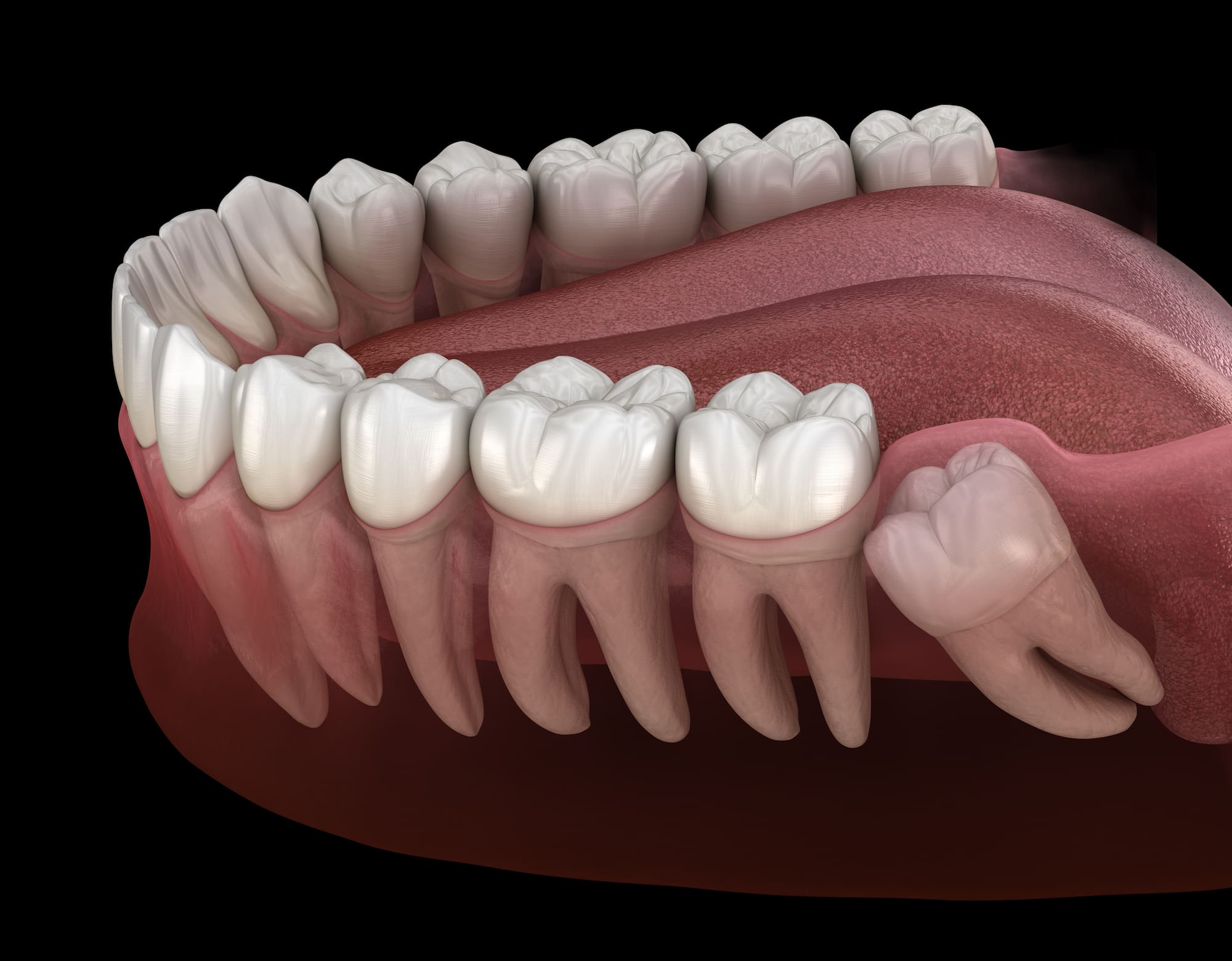 Extraction of wisdom teeth