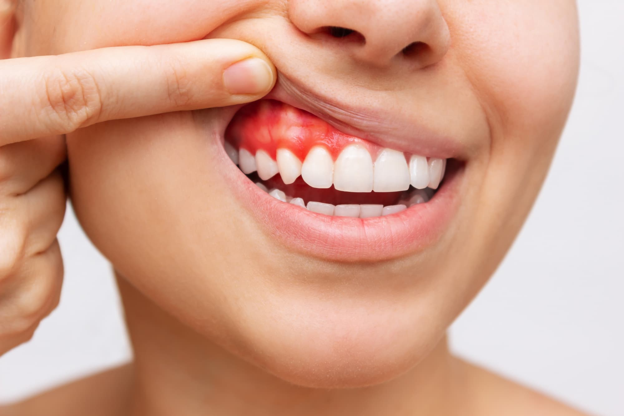 Gum disease